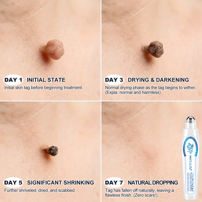 𝐇𝐈𝐒𝐊𝐈𝐍®👩‍⚕️ 𝟕-𝐃𝒂𝘆 𝐒𝗸𝐢𝐧 𝐓𝒂𝗴 & 𝐒𝐩𝙤𝐭 𝐄𝐫𝒂𝐬𝙚𝐫 Painless & Scar-Free Advanced Imperfection Removal Rollerball Pen✨